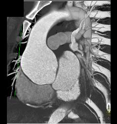 Dilated Sinus of Valsalva in Marfan Syndrome Patient - CTisus CT Scan