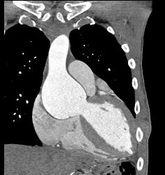 Dilated Sinus of Valsalva in Marfan Syndrome Patient - CTisus CT Scan