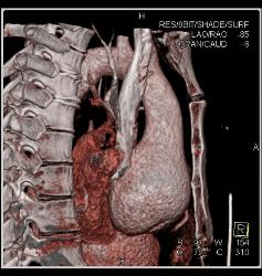 Dilated Sinus of Valsalva in Marfan Syndrome Patient - CTisus CT Scan