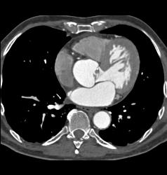 Dilated Sinus of Valsalva in Marfan Syndrome Patient - CTisus CT Scan