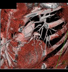 Dilated Sinus of Valsalva in Marfan Syndrome Patient - CTisus CT Scan