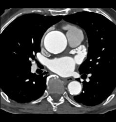 Normal Atrial Appendage - CTisus CT Scan