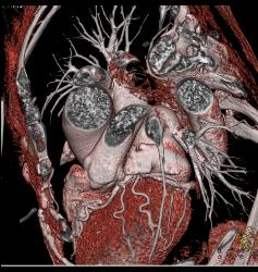 Normal Atrial Appendage - CTisus CT Scan