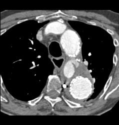 Endovascular Stent Repair With Endoleak- See Full Sequence - CTisus CT Scan