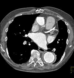 Endovascular Stent Repair With Endoleak- See Full Sequence - CTisus CT Scan