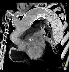 Endovascular Stent Repair With Endoleak- See Full Sequence - CTisus CT Scan