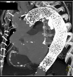 Endovascular Stent Repair With Endoleak- See Full Sequence - CTisus CT Scan