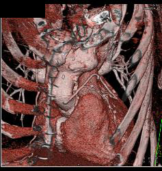 Endovascular Stent Repair With Endoleak- See Full Sequence - CTisus CT Scan