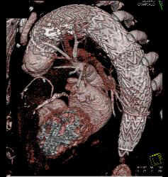 Endovascular Stent Repair With Endoleak- See Full Sequence - CTisus CT Scan