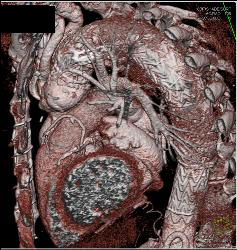 Endovascular Stent Repair With Endoleak- See Full Sequence - CTisus CT Scan