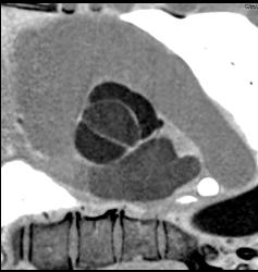 Open Bicuspid Aortic Valve - CTisus CT Scan