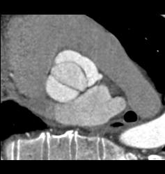 Open Bicuspid Aortic Valve - CTisus CT Scan