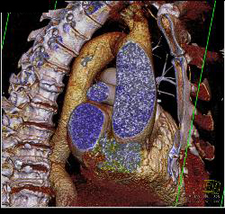 Open Bicuspid Aortic Valve - CTisus CT Scan