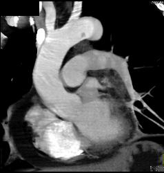 Clot in Arch - CTisus CT Scan