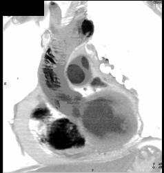 Clot in Arch - CTisus CT Scan