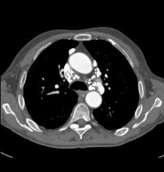 Calcified Nodes Due to Prior Granulomatous Disease - CTisus CT Scan