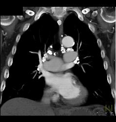 Calcified Nodes Due to Prior Granulomatous Disease - CTisus CT Scan