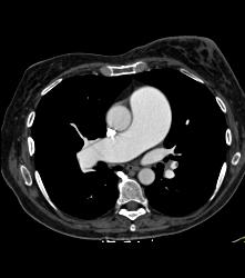 Dilated Pulmonary Artery - CTisus CT Scan