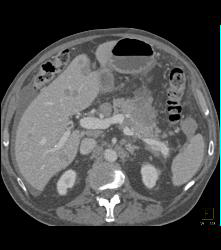 Lymphoma With Abdominal Disease - CTisus CT Scan