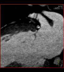 Left Anterior Descending Coronary Artery (LAD) and Right Coronary Artery (RCA) Disease - CTisus CT Scan