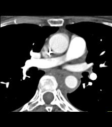 Intramural Hematoma - CTisus CT Scan