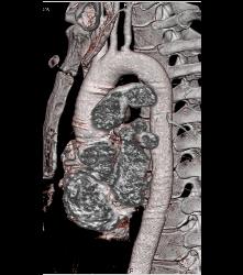 Intramural Hematoma - CTisus CT Scan