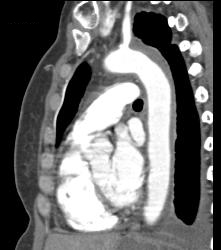 Intramural Hematoma - CTisus CT Scan