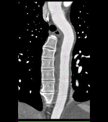 Intramural Hematoma - CTisus CT Scan