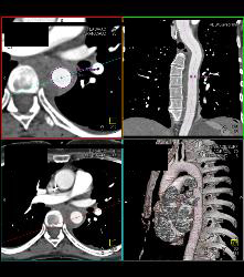 Intramural Hematoma - CTisus CT Scan