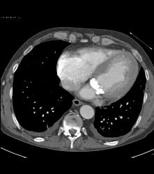 Mitral Annulus Calcification - CTisus CT Scan