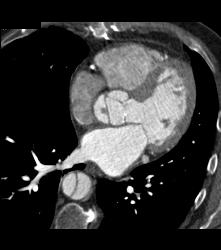 Type A Dissection- See Full Sequence - CTisus CT Scan