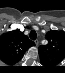 Type A Dissection- See Full Sequence - CTisus CT Scan