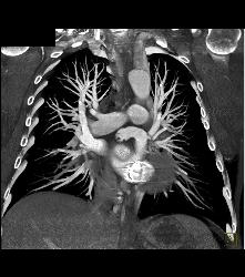 Prior Repair of Coarctation of the Aorta - CTisus CT Scan