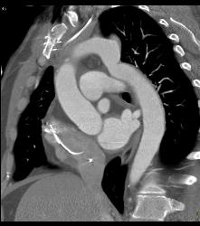 Prior Repair of Coarctation of the Aorta - CTisus CT Scan