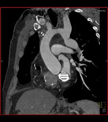 Prior Repair of Coarctation of the Aorta - CTisus CT Scan