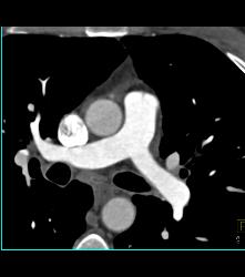 Pseudo-clot in SVC - CTisus CT Scan