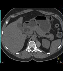 Bronchogenic Cyst Presents as Mass Off Diaphragm - CTisus CT Scan