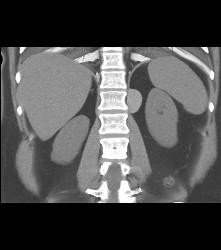 Bronchogenic Cyst Presents as Mass Off Diaphragm - CTisus CT Scan