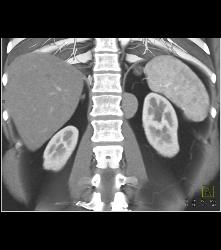 Bronchogenic Cyst Presents as Mass Off Diaphragm - CTisus CT Scan