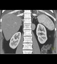 Bronchogenic Cyst Presents as Mass Off Diaphragm - CTisus CT Scan