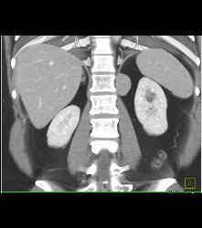 Bronchogenic Cyst Presents as Mass Off Diaphragm - CTisus CT Scan