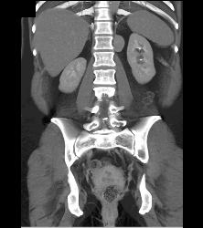 Bronchogenic Cyst Presents as Mass Off Diaphragm - CTisus CT Scan