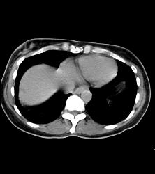 Breast Cancer on CT and Pet - CTisus CT Scan