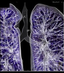 Right Aortic Arch With Compression on Right Side of the Trachea - CTisus CT Scan