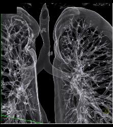 Right Aortic Arch With Compression on Right Side of the Trachea - CTisus CT Scan