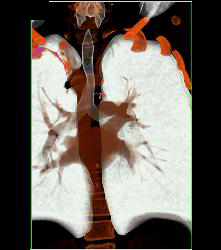 Right Aortic Arch With Compression on Right Side of the Trachea - CTisus CT Scan