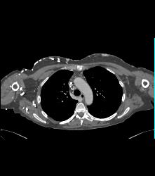 SVC Occlusion With Extensive Collaterals in Chest Wall - CTisus CT Scan