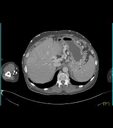 SVC Occlusion With Extensive Collaterals in Chest Wall - CTisus CT Scan