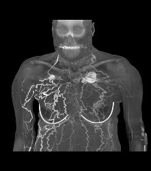 SVC Occlusion With Extensive Collaterals in Chest Wall - CTisus CT Scan