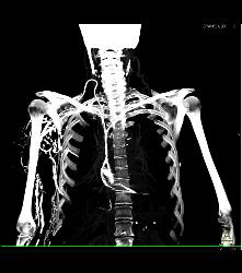 SVC Occlusion With Extensive Collaterals in Chest Wall - CTisus CT Scan